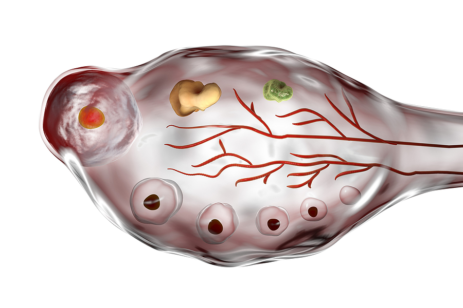 CACI for Polycystic Ovary Syndrome