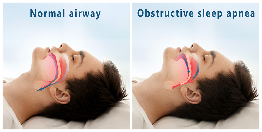 Obstructive Sleep Apnea Treatment for Pilots