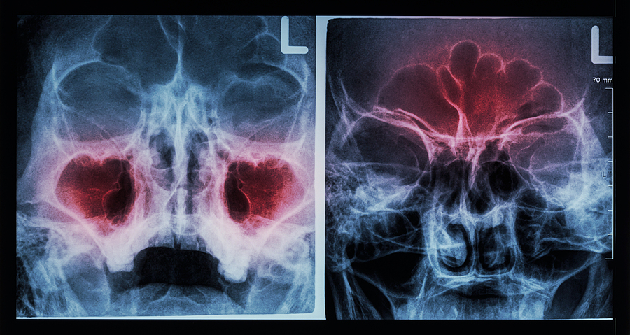 Sinus inflammation